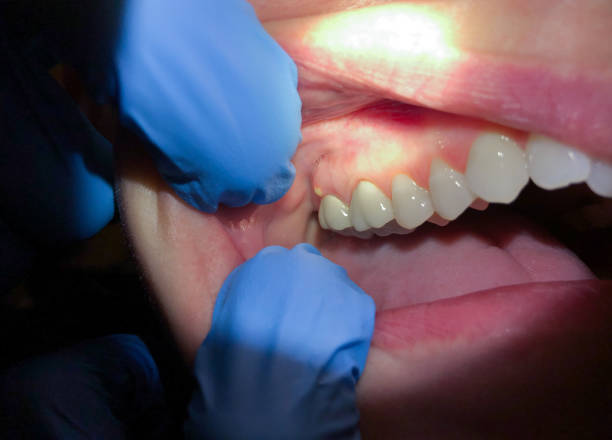 Best Dental Abscess Treatment in Vardaman, MS